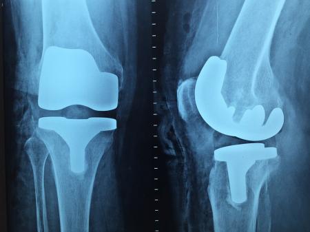 eliminarea durerii la nivelul articulațiilor genunchiului și șoldului